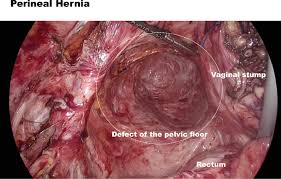 Puntambekar presents a detailed systematic approach to navigating key anatomical landmarks. Laparoscopic Mesh Repair For Perineal Hernia After En Bloc Resection Of An Aggressive Angiomyxoma Using A Modified Sacral Colpopexy Technique Journal Of Minimally Invasive Gynecology
