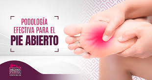 Pies Abiertos Sintomas Y Tratamiento Para Tu Salud Podal