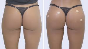 Aumento Glúteos Con Ácido Hialurónico-Clínicas Diego de León