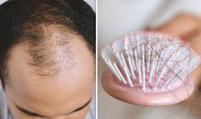 The capillusrx laser therapy cap is a hair loss treatment device available through our office that combines low level light therapy with exceptional portability and convenience.the light source is transmitted through a hermetically sealed dome that fits inside a baseball cap, or hat. Hair Loss Treatment Laser Therapy Can Promote New Hair Strands Express Co Uk