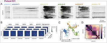 It can also increase the intensity and how often the seizures happen. Seizure Pathways Change On Circadian And Slower Timescales In Individual Patients With Focal Epilepsy Pnas