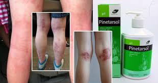 Kegatalan disebabkan alahan selalunya disebabkan penghasilan histamin oleh badan. Penawar Yang Berkesan Untuk Kulit Gatal Ruam Pengidap Ekzema Dan Penyakit Kulit