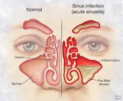 Mayo Clinic On Twitter Chronic Sinusitis Sinus Medication Sinus Infection