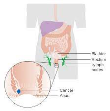 Anal cancer - Wikipedia