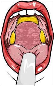 Image result for Tonsillitis