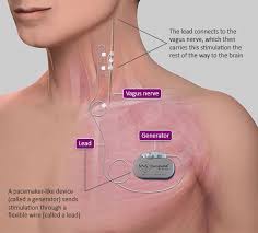 Vns Therapy Implant My Son Just Got Vagus Nerve Nerve Stimulator Vagus Nerve Stimulator