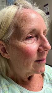 Life changing transformation for one of my sweetest patients. She had a  conplete face makeover including a brow lift, upper and lower eyelid lift,  face and neck lift, and laser resurfacing. What do ...