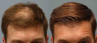Nutritional factors and hair loss. clinical and experimental dermatology 27.5 (2002): How To Tell If A Hair Transplant Is Right For You Biomedj