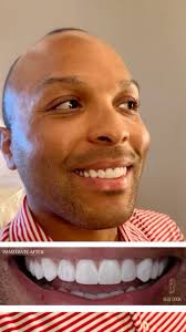 Such a fun HALŌ Veneer before and after! 10 teeth were completed to achieve  this look! , Brighter ✅, Fuller ✅, Non-invasive ✅, ABOUT HALO VENEERS:, •  Completely additive, no shaving of teeth * No ...