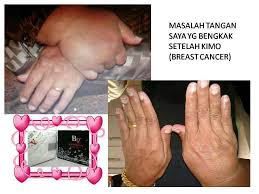 Blog Amyu Tangan Membengkak Selepas Kimo