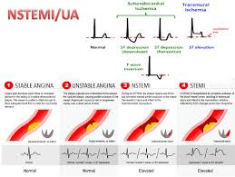You might be thinking, that it's obvious, and that the difference is in the name. Coronary Syndrome Ua Nstemi