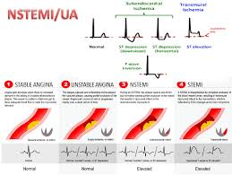 Liegt ein nstemi vor, hat dies konsequenzen für die therapie: Coronary Syndrome Ua Nstemi