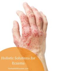 Atopic Dermatitis Excema Eczema Remedies Eczema Home Remedies For Eczema
