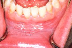 It is also a very important sign of throat cancer. Mouth Cancer Pictures What Oral Cancer Sores Look Like
