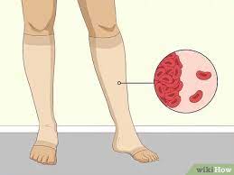 Clotting of the blood is a normal bodily function. How To Clear Blood Clots Can Natural Remedies Help