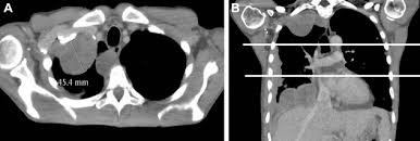 Tends to cause inward contraction of the hemithorax, e.g. The Iaslc Mesothelioma Staging Project Proposals For Revisions Of The T Descriptors In The Forthcoming Eighth Edition Of The Tnm Classification For Pleural Mesothelioma Journal Of Thoracic Oncology