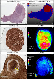 Show your support by donating via paypal! Molecular Signatures Of Medullary Thyroid Carcinoma By Matrix Assisted Laser Desorption Ionisation Mass Spectrometry Imaging Sciencedirect