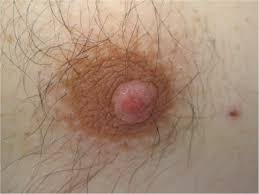 The risk of breast cancer is much lower in men than in women. Paget S Disease Of The Male Breast An Unusual Case In A Young Man And Literature Review Sciencedirect