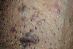 A first outbreak of herpes in the genitals. 22 Shaving Ideas Ingrown Hair Essential Oil For Bronchitis Essential Oil For Hives
