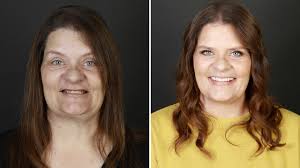 Domestic violence survivor shows off new smile after surgery in Brooklyn