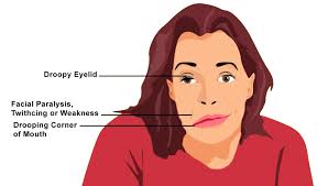 Image result for Pupillary Paralysis