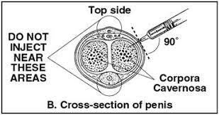 Image result for Intraurethral Alprostadil