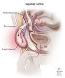 Image result for icd 10 code for l inguinal hernia