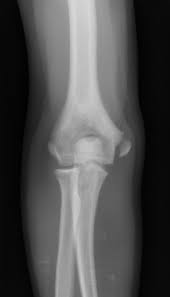 The medial epicondyle is located on the inside of the elbow. Acute Avulsion Fractures Of The Medial Epicondyle While Throwing In Youth Baseball Players A Variant Of Little League Elbow Sciencedirect