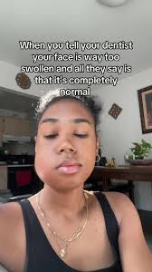 Swollen Face After Wisdom Teeth Removal: Day 3 and Beyond