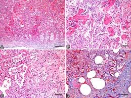 Check spelling or type a new query. Scielo Brasil Clinical And Pathological Aspects Of Idiopathic Pulmonary Fibrosis In Cats Clinical And Pathological Aspects Of Idiopathic Pulmonary Fibrosis In Cats