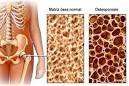 Osteoporosis
