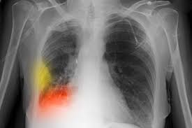Image result for lung cancer xray