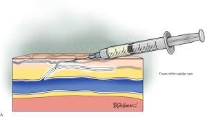 To describe the results of intralesional injection of the sclerosing agent sodium tetradecyl sulfate in patients with lymphangioma. Treatment Of Spider Telangiectasias Sciencedirect