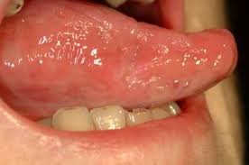 Image result for mouth ulcer on tongue)