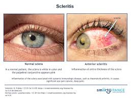 Image result for Scleritis