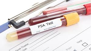 After radiation therapy, the most widely accepted definition is a psa that rises from the lowest level (nadir) by 2.0 ng/ml or more. Does A High Psa Level Mean I Have Prostate Cancer Huffpost