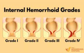 Image result for Hemorrhoid
