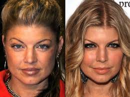 Fergie Ordinary Face And Glamour Face Celebrity Plastic Surgery Fergie Plastic Surgery Plastic Surgery