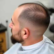 Best Hair Transplant In Islamabad ...