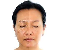 Image result for Melasma
