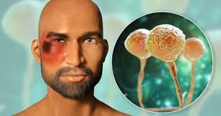 Confirman la muerte del segundo caso de hongo negro en Choluteca.