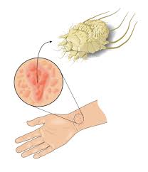 Image result for scabies on humans