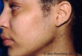 Coarse hair fertility hair growth drugs facial female hair growing facial treatment facial care. Hirsutism American Osteopathic College Of Dermatology Aocd