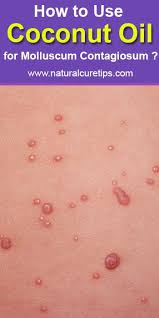 Coconut Oil For Molluscum Contagiosum Treatment Coconut Oil Uses Coconut Oil Coconut Oil Hair Growth