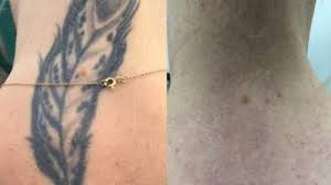 20 questions to ask before laser tattoo removal Permanent Makeup Removal Laser London Saubhaya Makeup