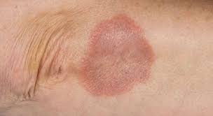 Rheumatic fever nodules are typically associated with acute rheumatic fever in children. Granuloma Annulare Hays Ks Dermatologist