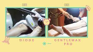 4.8 out of 5 stars 25. Diode Vs Gentlemax Pro Laser Hair Removal By Wink Laser Studio Youtube