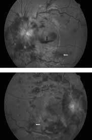 Image result for Acute Vision Loss