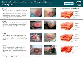 ulcer classification scottish adapted european pressure ulcer advisory panel epuap pressure ulcer wound care nursing burns nursing