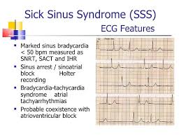 27 Sick Sinus Syndrome Ideas Heart Rhythms Syndrome Sick